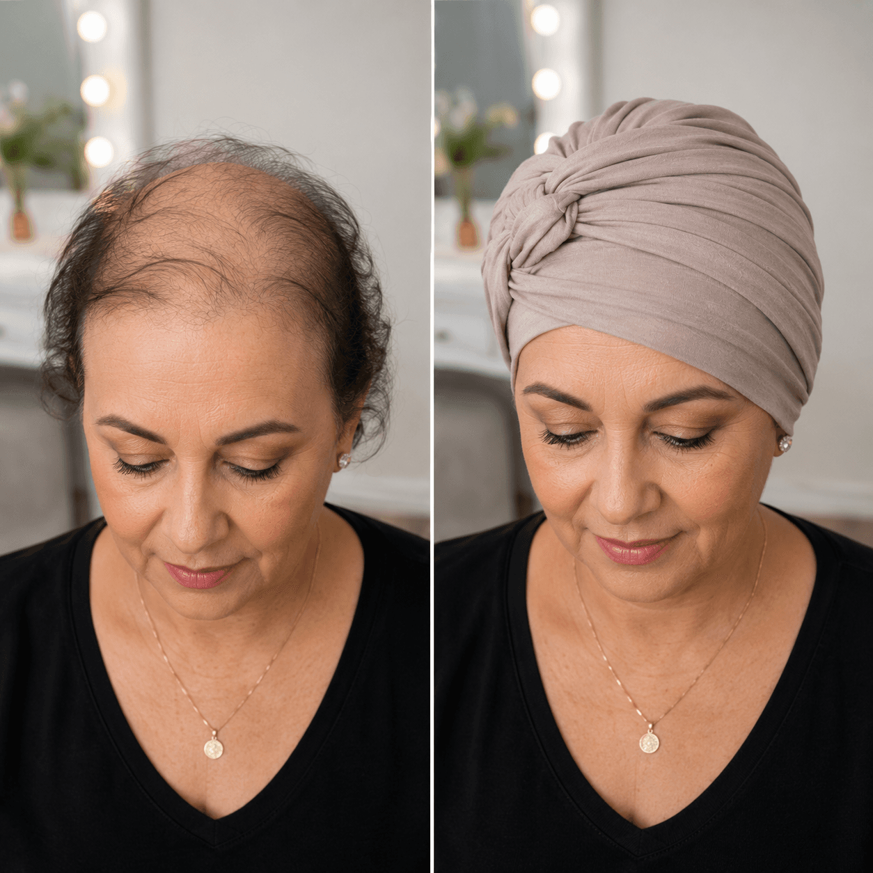 Before and After Medical Hair Loss Recovery Transformation 1